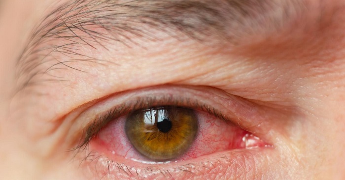 czerwone oczy po jaraniu