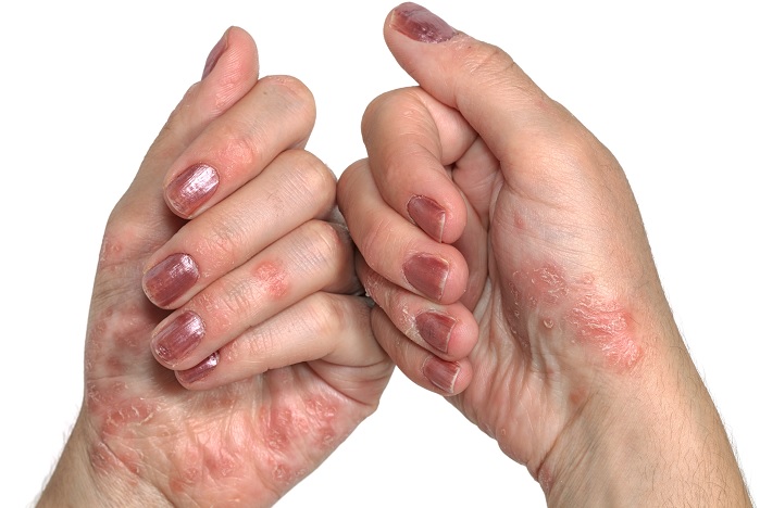 Olejek CBD na grzybice